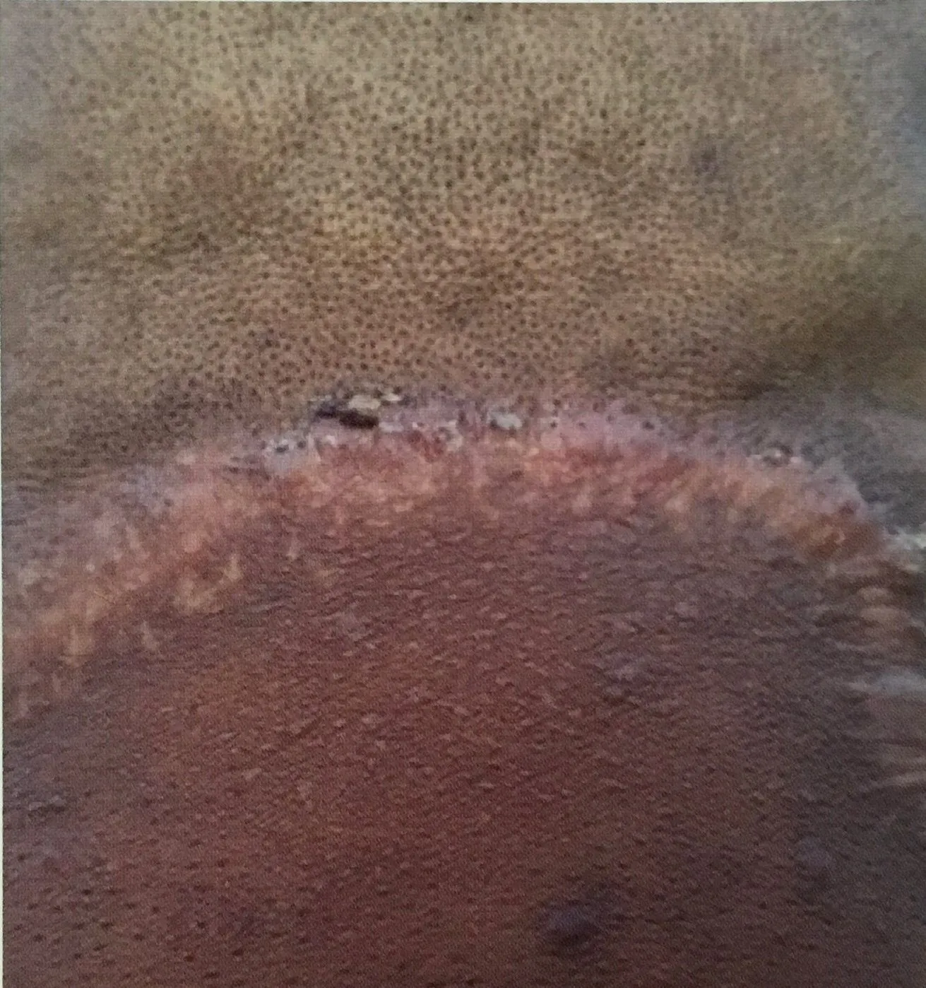 keloid start