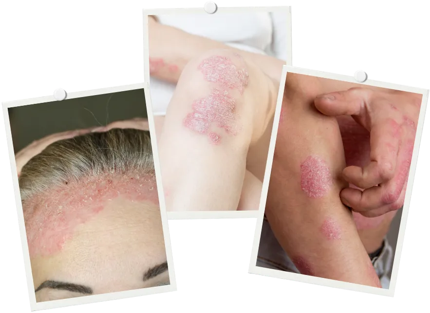 Psoriasis