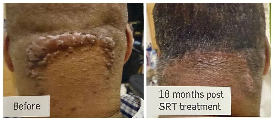 before and after keloids treatment