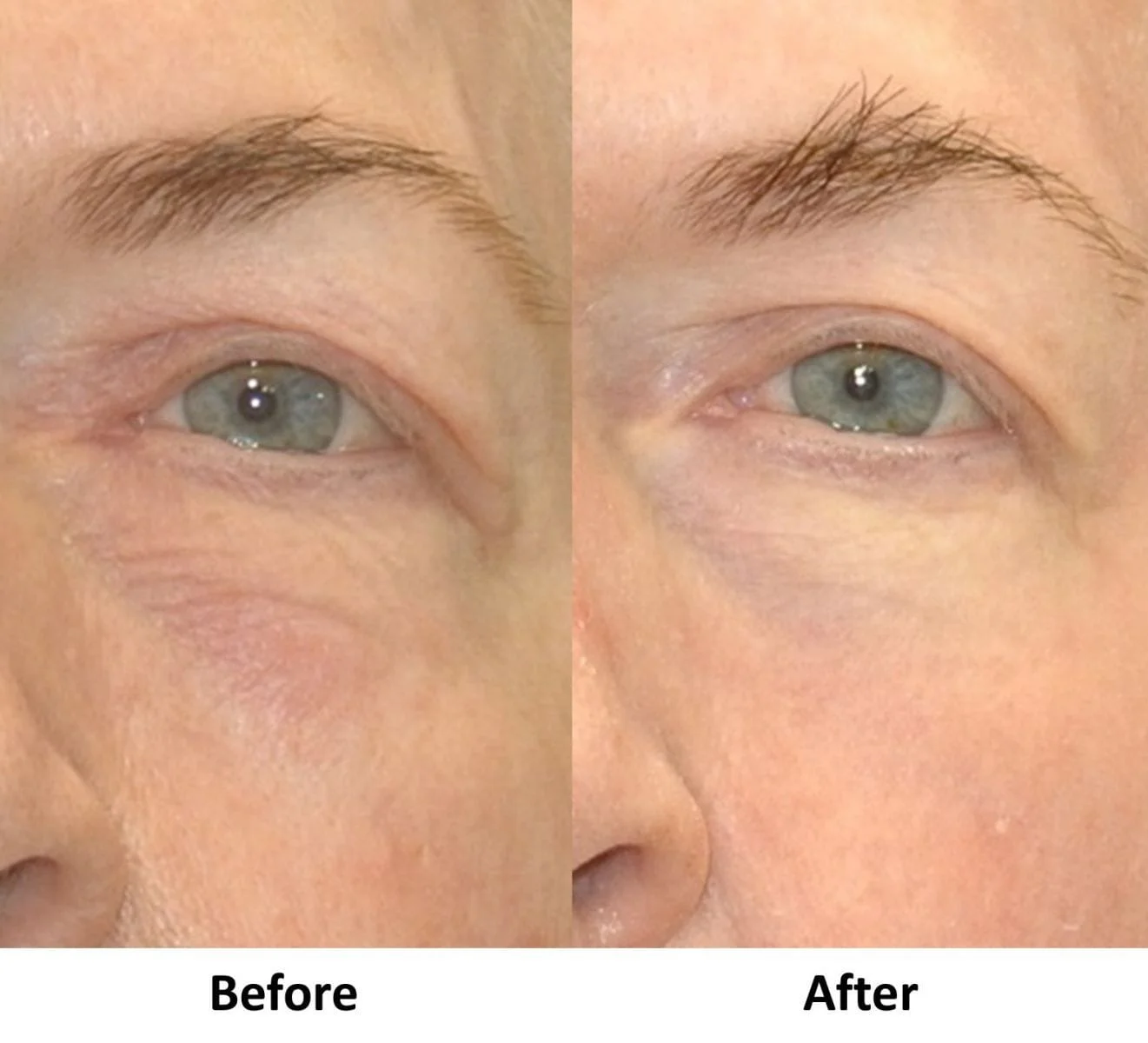 Before and After Care Instructions for Fractional CO2 Laser Treatment