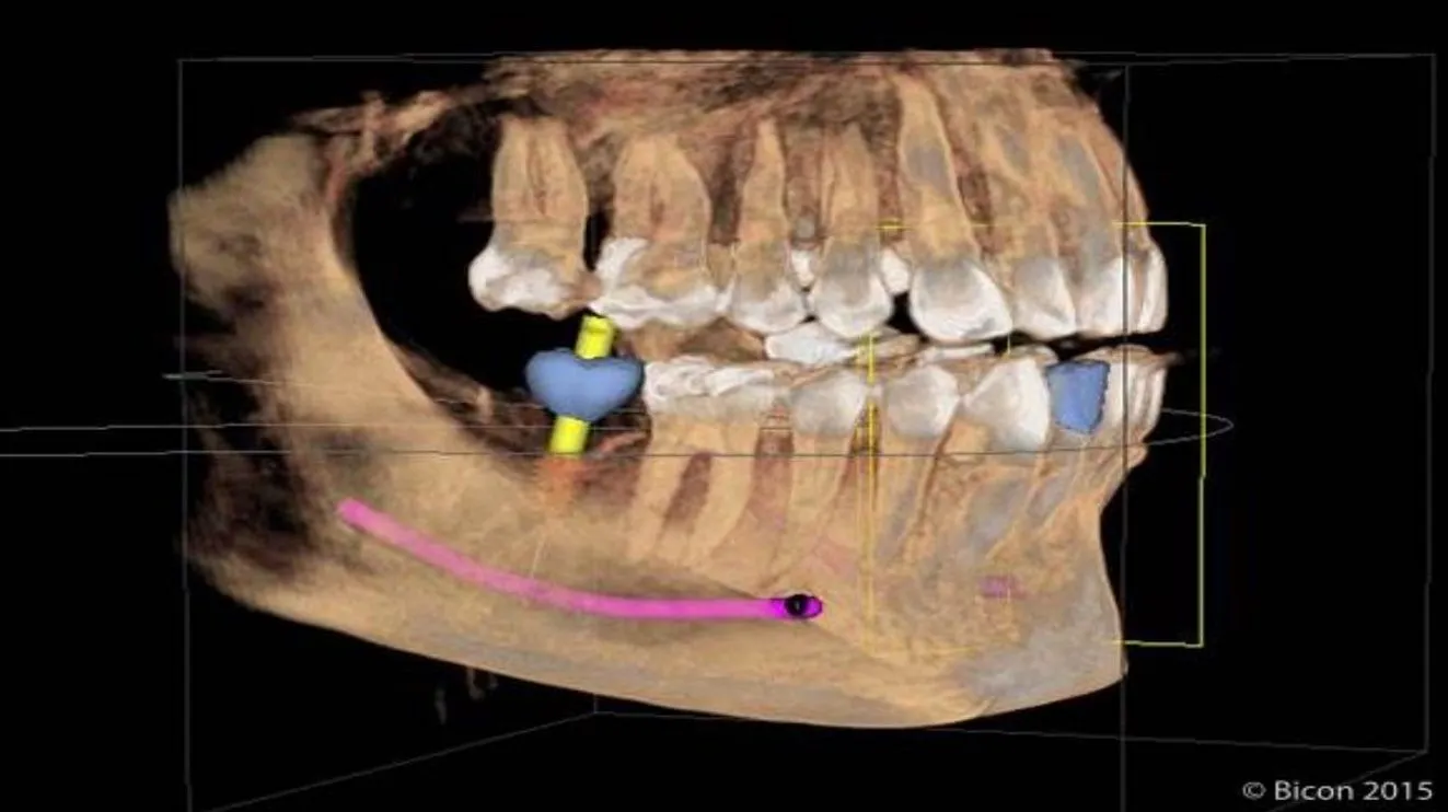 Cerec Guided Dental Implants Creve Coeur, MO