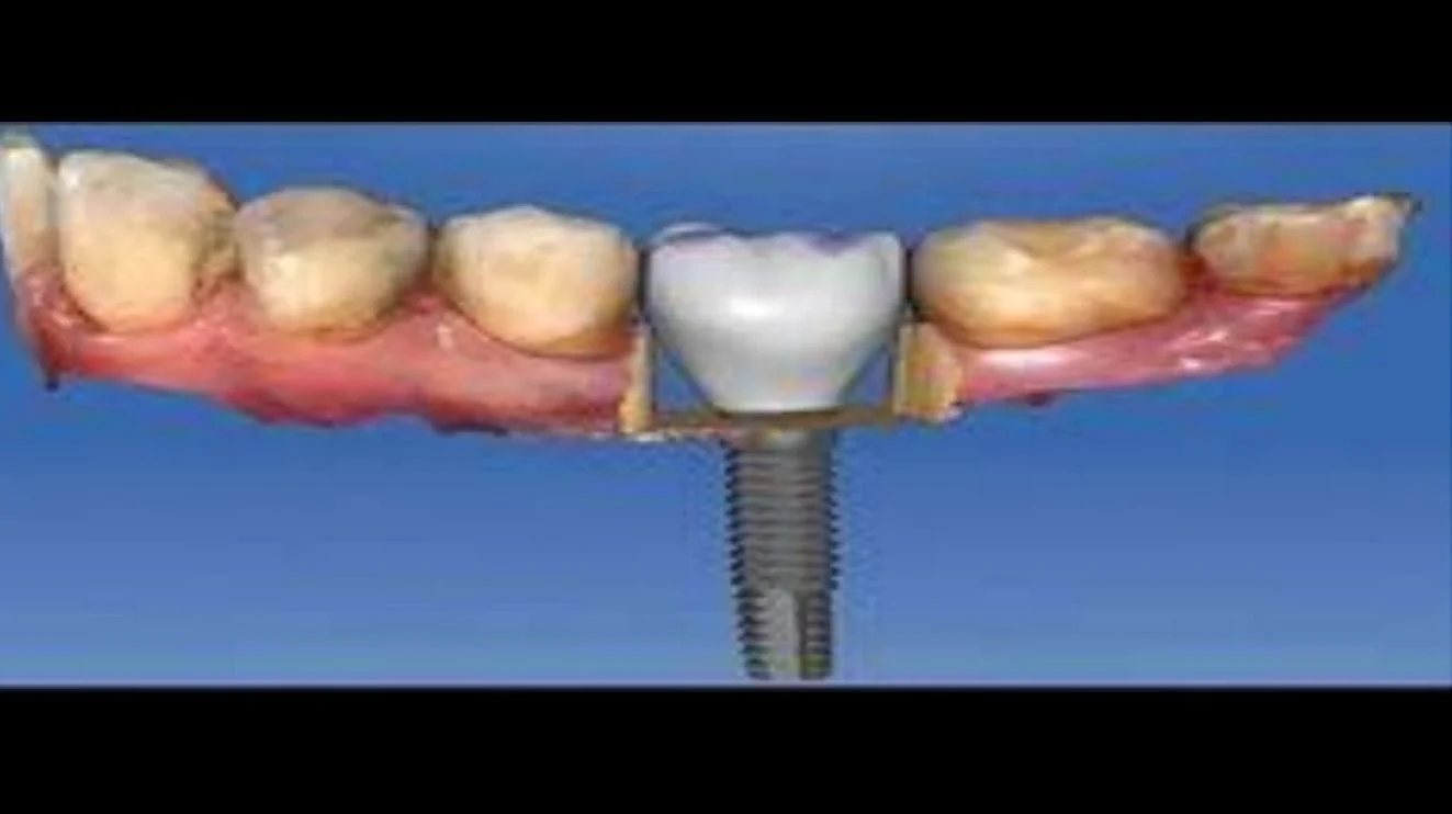 Dental Implant Placement Creve Coeur, MO