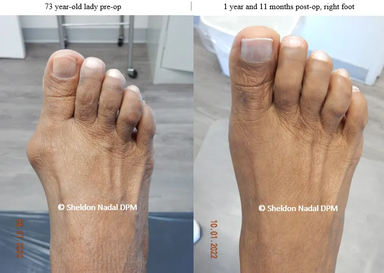 BEFORE &copy; Sheldon Nadal DPM AFTER