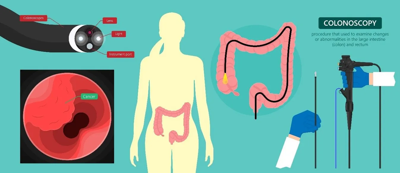 Endoscopic Mucosal Resection EMR | Gastroenterologist In Forest Hills ...