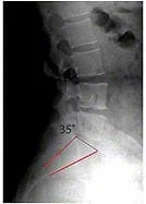 Low Back X-ray (Lumbar X-ray) - After Chiropractic Treatment - Normal Low Back Curve
