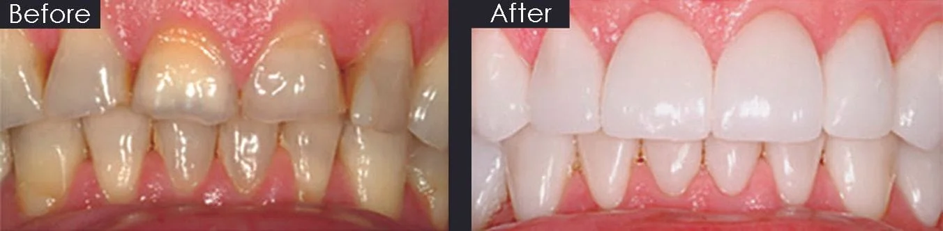 Before and after image of yellowed misshapen teeth before teeth whitening and dental crowns Royal Palm Beach, FL dentist