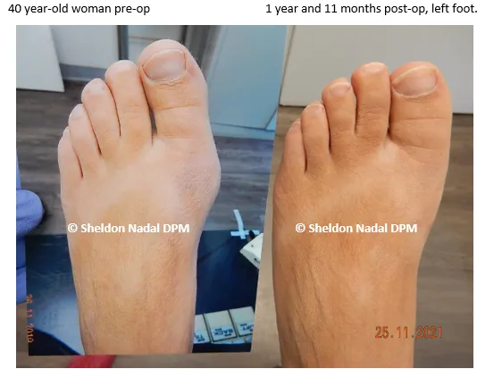 BEFORE &copy; Sheldon Nadal DPM AFTER