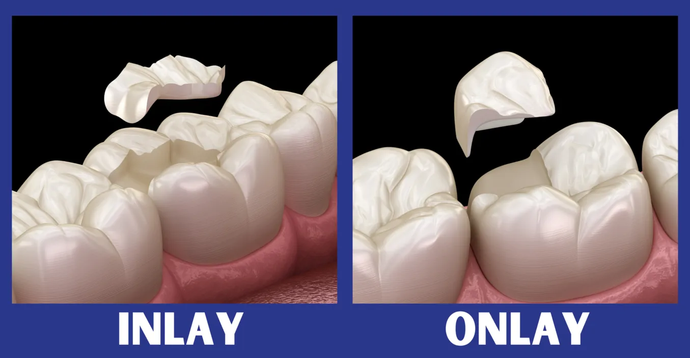 inlayonlay
