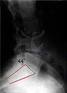 Low Back X-ray (Lumbar X-ray) - Before Chiropractic Treatment - Excessive Low Back Curve (Swayback, Anterior Pelvic Tilt)