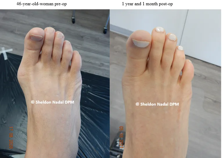 BEFORE &copy; Sheldon Nadal DPM AFTER