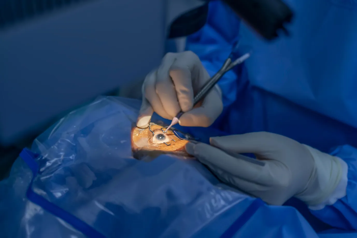 Cornea Transplant