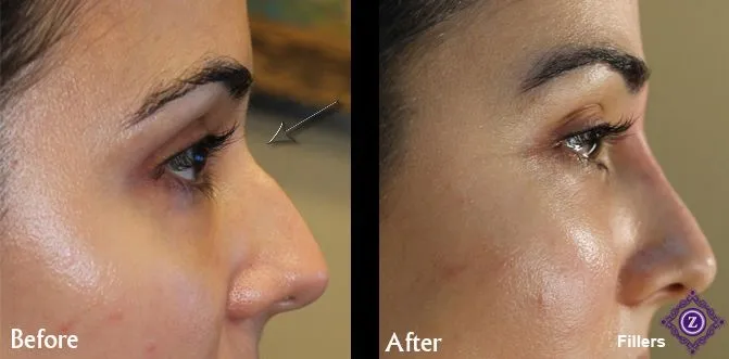 Nose Reshaping 