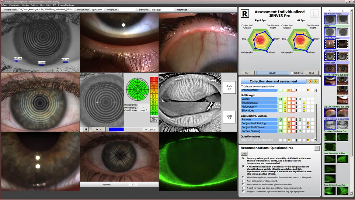 Dry Eye Testing Oculus