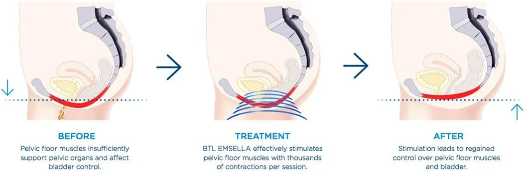 erectile dysfunction treatment with emsella in winter park