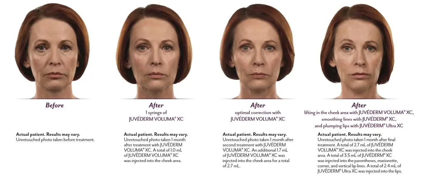 Injectable Dermal Fillers