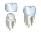 illustration of dental crown being placed on tooth, Olympia Fields, IL dental crowns and bridges