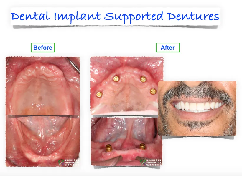 Before & After Dental Implants Shelby | Washington | Clinton Township MI