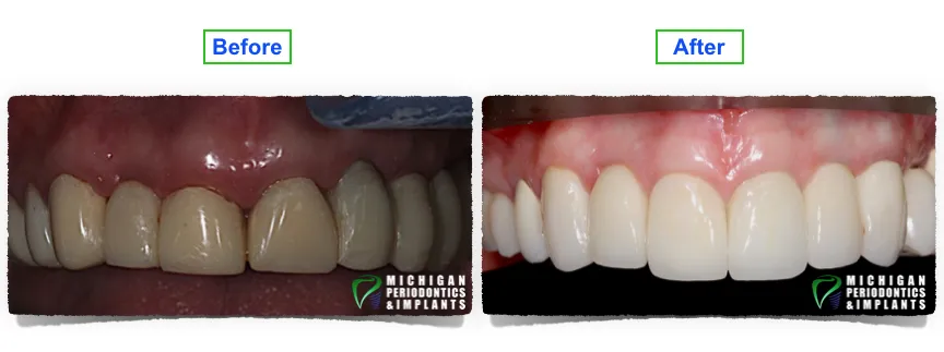 Before & After Dental Implants from best Periodontist Birmingham MI