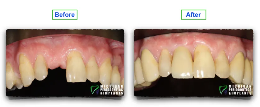 Before & After Dental Implants Macomb- Clinton | Washington | Shelby Township