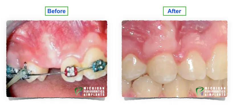 Before & After Dental Implants Royal Oak & Warren MI