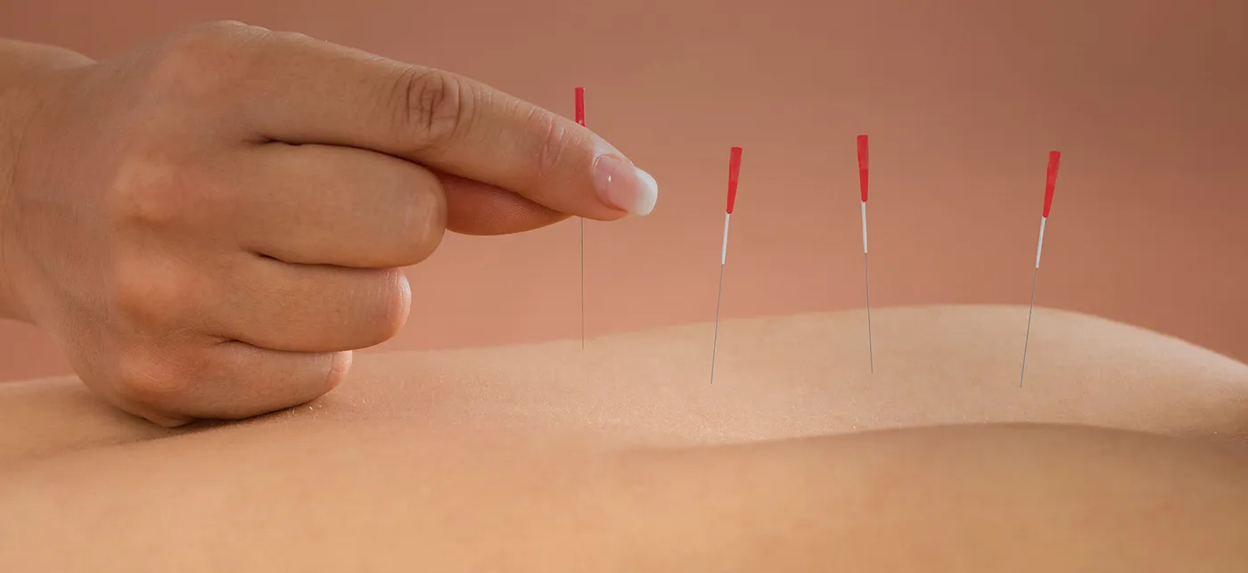 ​Acupuncture​