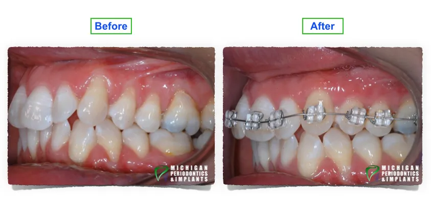 Before & After Dental Implants from Periodontist Washington Township