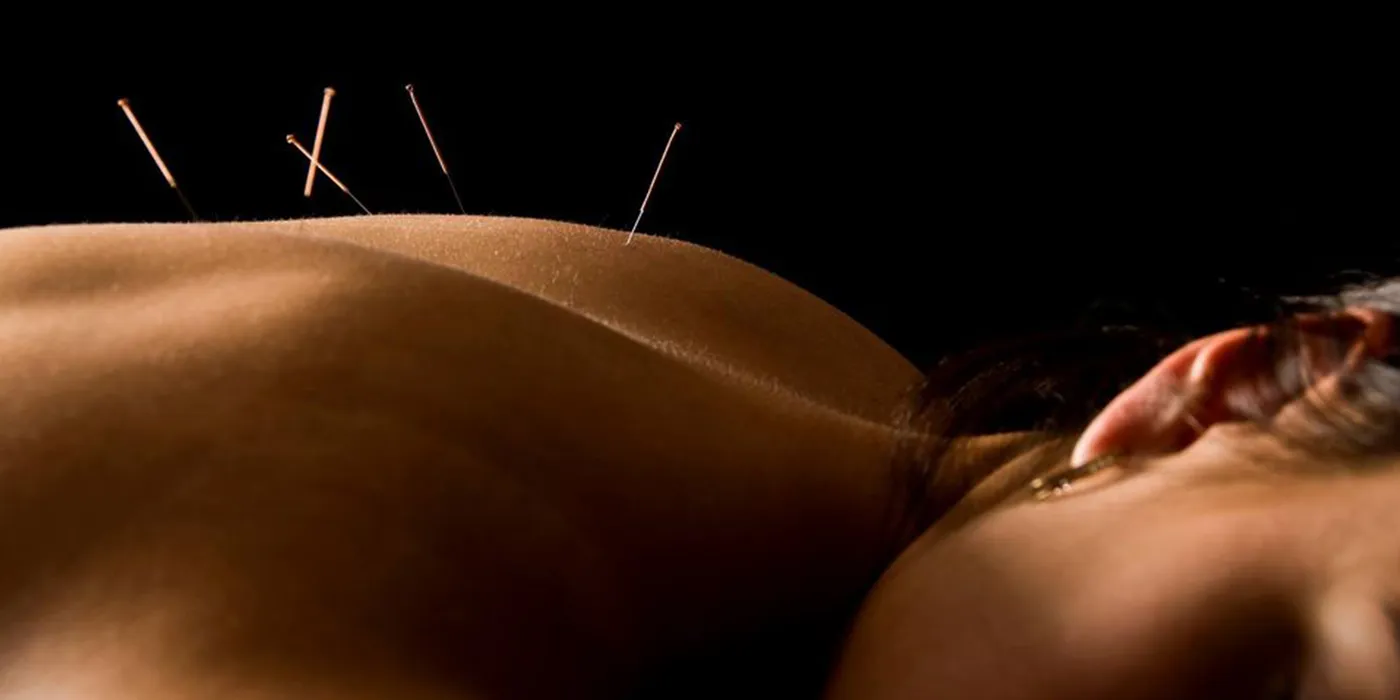 Acupuncture