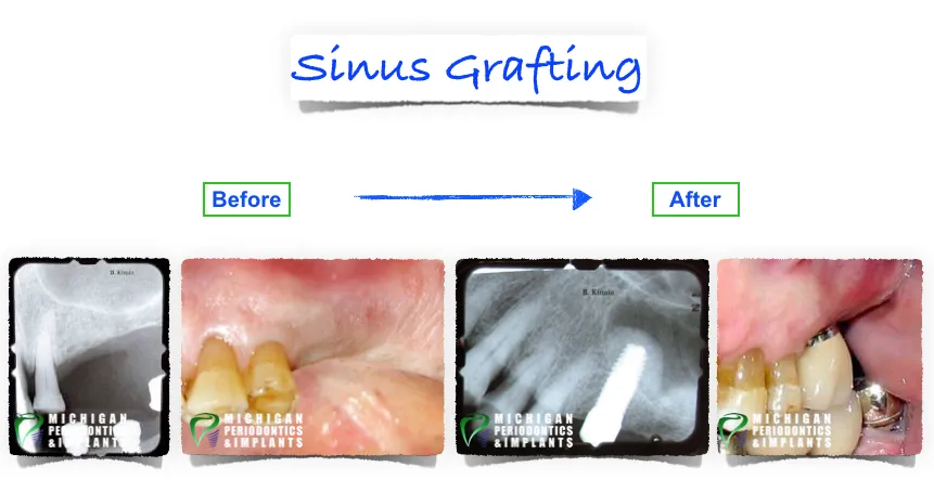 Before & After Dental Implants Bloomfield | Rochester Hills