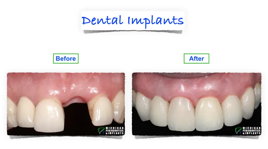 Dental Implants Birmingham MI