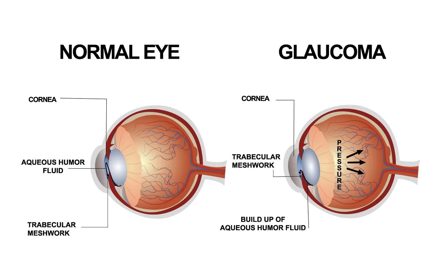 Glaucoma FAQs