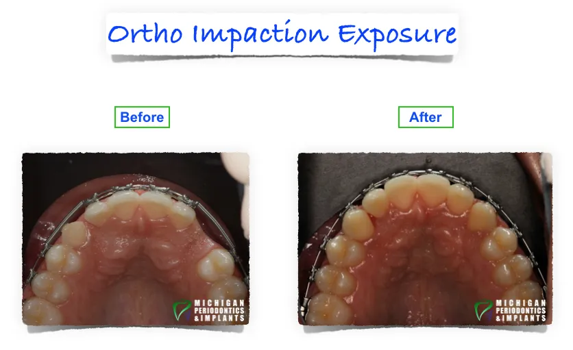 Before & After Dental implants Troy | Macomb MI