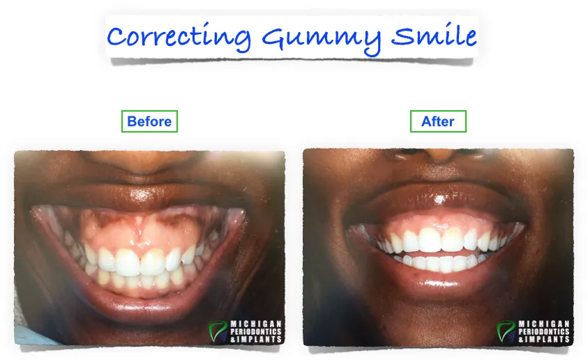 Before & After Dental implants Rochester hills MI