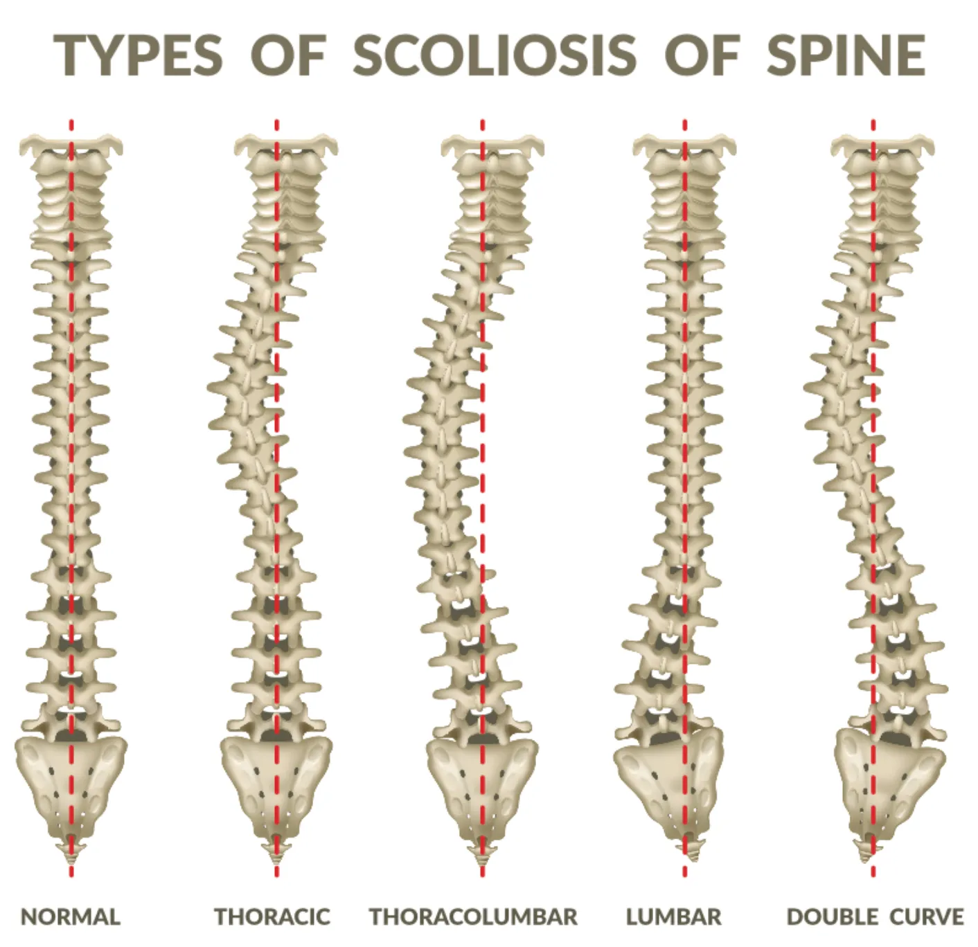 Breaking Down the Braces Used to Correct Scoliosis – Chiropractic