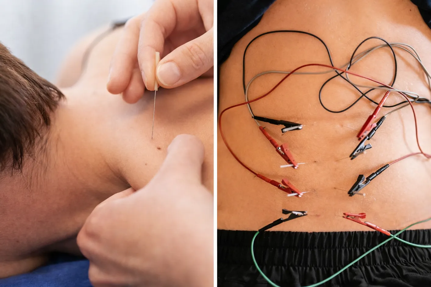Trigger Point Dry Needling