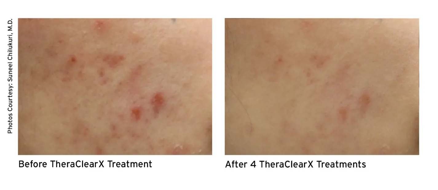 Before and after - Cheek