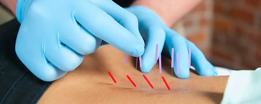 Dry Needling