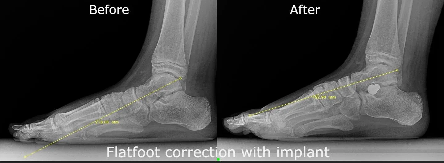 Flatfoot
