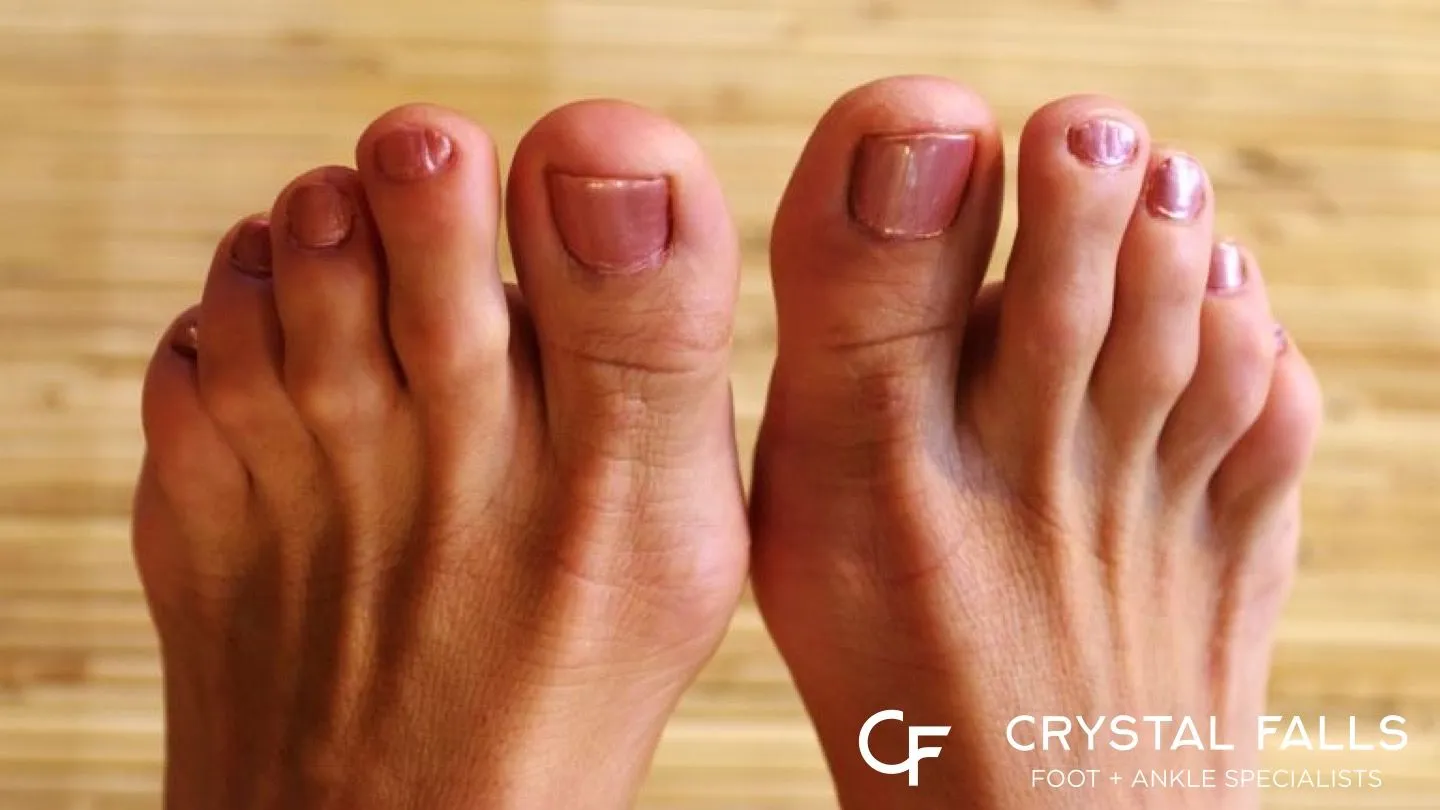 Bunions Hammertoes Podiatrist In Leander TX Crystal Falls