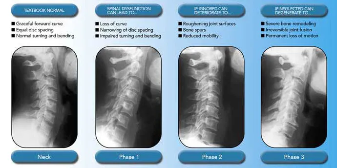 Spinal Decay