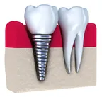illustration of dental implant screwed in next to real tooth with roots, Cedar Park, TX implant dentist