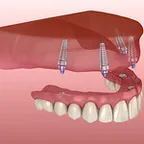 Implant Dentistry 