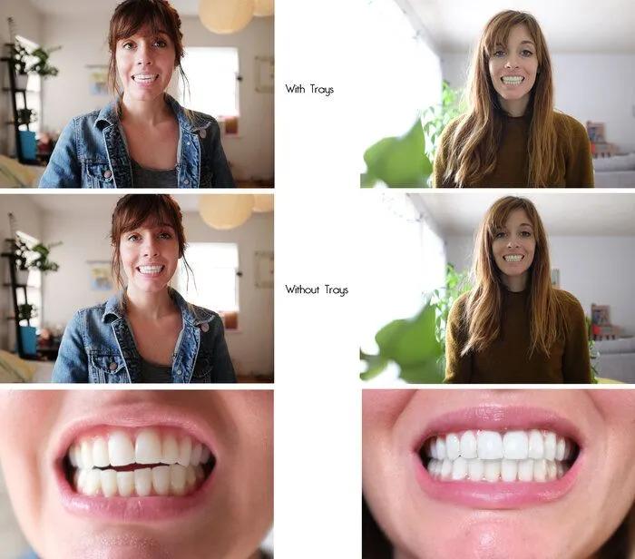 Comparison of a woman with and without Invisalign trays. The left column shows close-up and smiling photos with trays, and the right column shows the same without trays. The top two rows focus on the full face, while the bottom row highlights the close-up view of teeth, demonstrating the discreet appearance of Invisalign trays and the natural look without them.