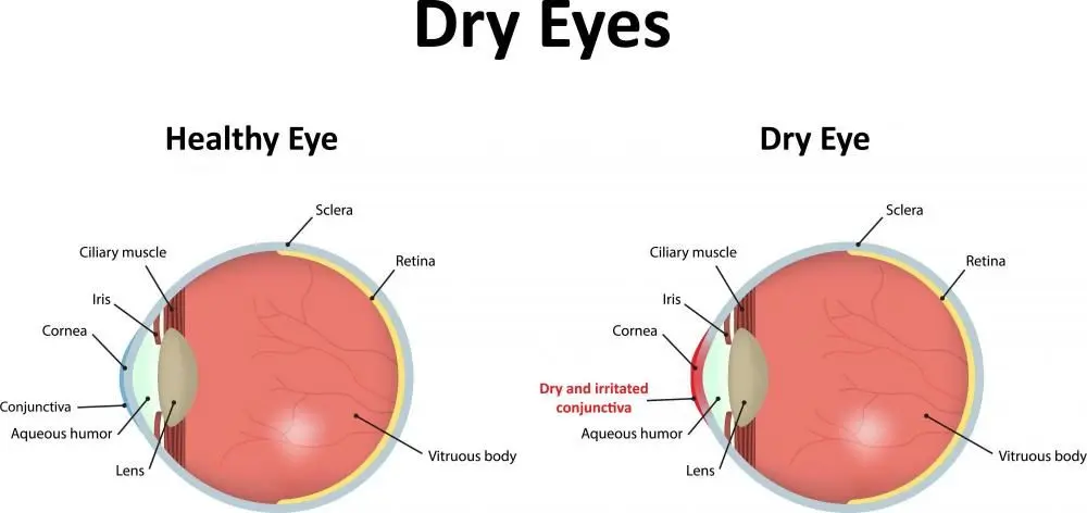 Dry eyes in Mt Pleasant, PA