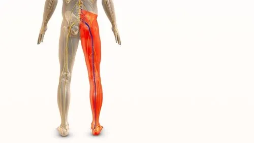 sciatica