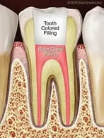 Root Canal Specialist Washington DC