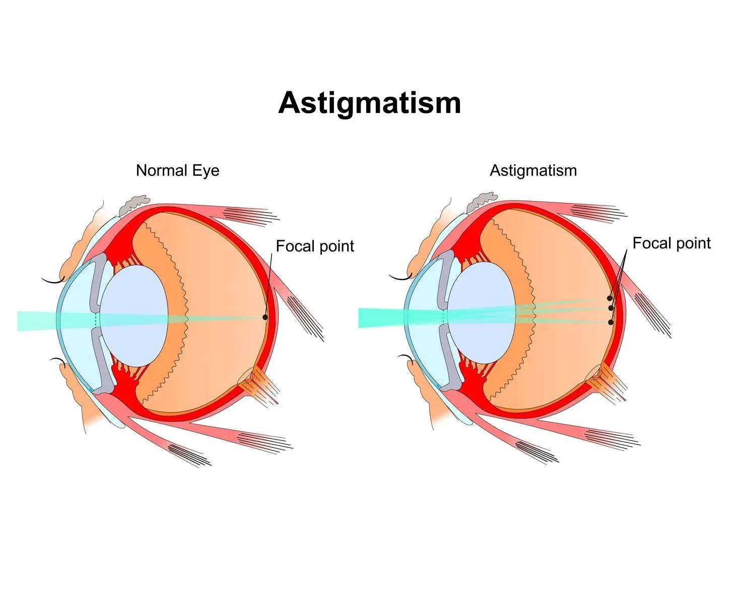 Astigmatism illustration