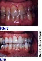 Teeth Whitening Ajax