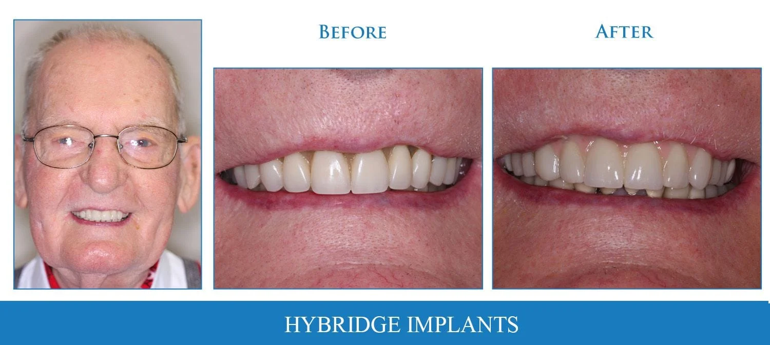 hybridge implants