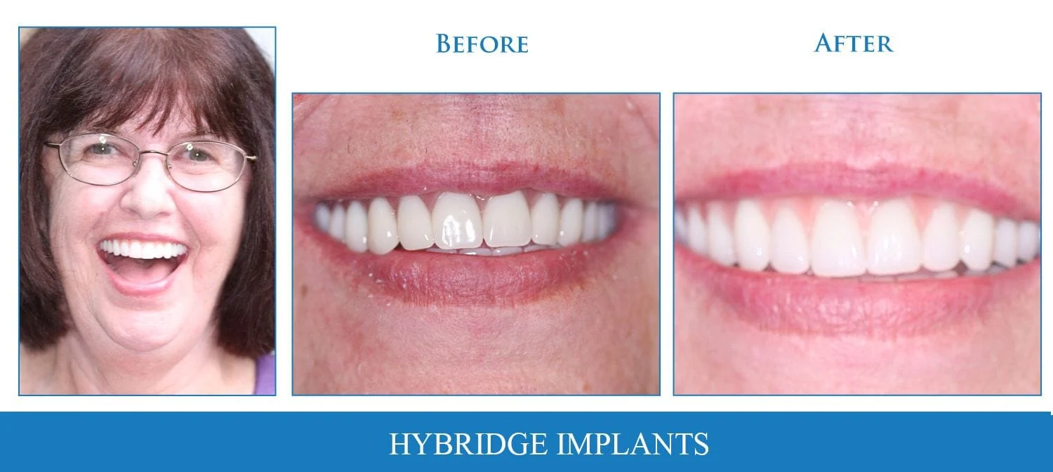 hybridge implants