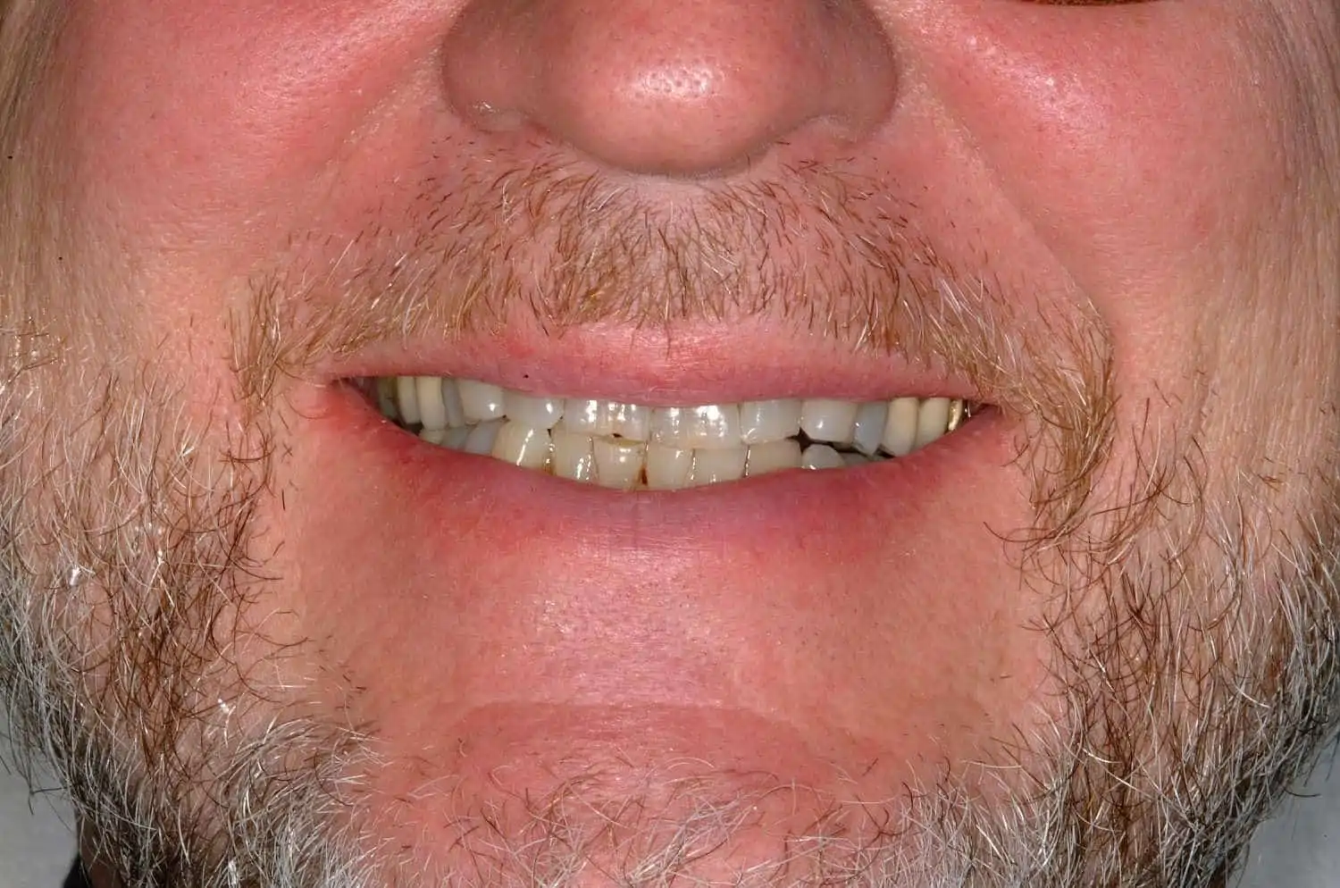 Corrected bite and shape of teeth